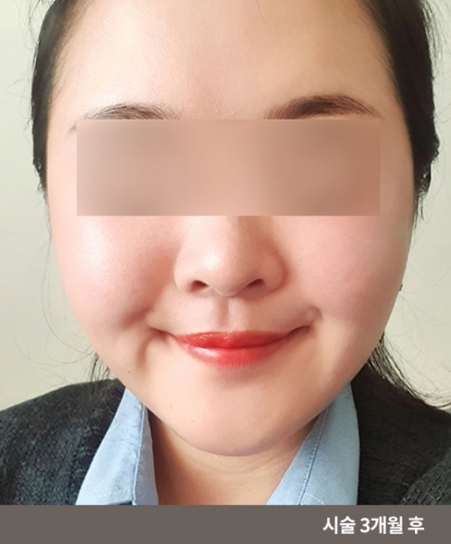Body Cut Injection – Full Body